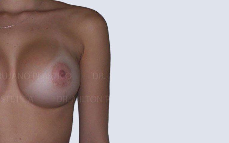 Cirugía de mamas