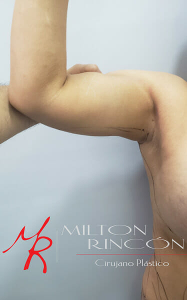 Pinzamientode la piel para diseñar la cirugíadiseña la cirugía