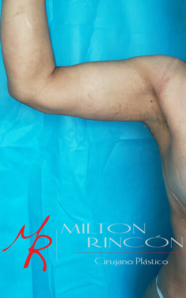 Varios meses después, disminución en los brazos y en la silueta