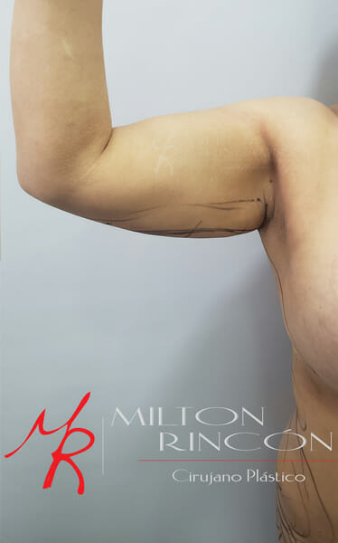 Exceso de piel flácida y tejido graso en brazos y tronco