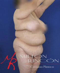 Mujer con obesidad