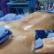 Cirugía marcación abdominal Dr. Milton Rincón